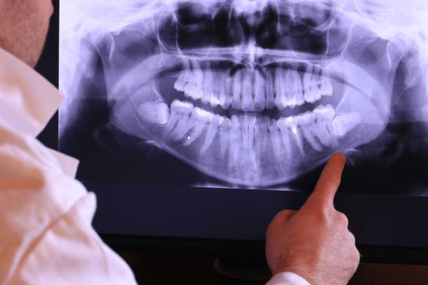 Best Emergency Wisdom Teeth Removal in Euclid, OH